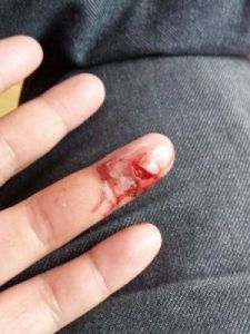 被狗狗咬到大拇指，持续流血的困扰