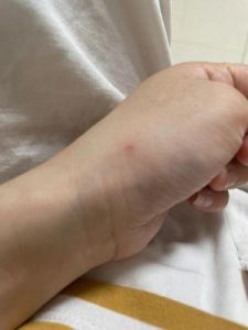被自家狗狗咬伤后，应该采取哪些措施来处理伤口？