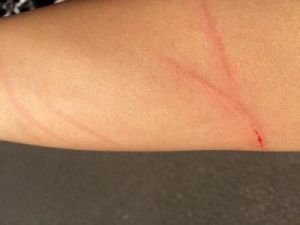 被自家狗狗抓伤后，如何安全有效地处理伤口？