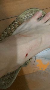 被狗咬的轻微伤图片，清晰展示伤口细节